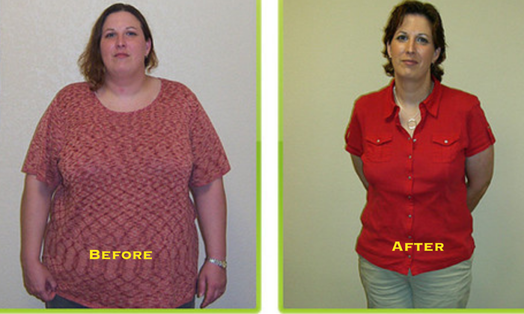 Bariatric Surgery Before and After: Transforming Lives and Health